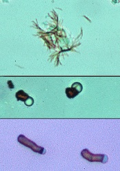 bilirubin crystals in urine